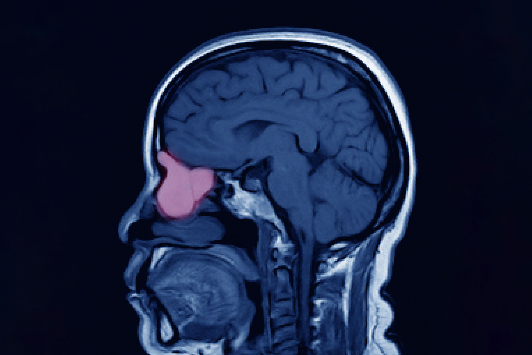 Sinonasal Tumours | Dr. Jonathan Yip | Nasal, Sinus and Skull Base Surgery | Calgary ENT Specialist