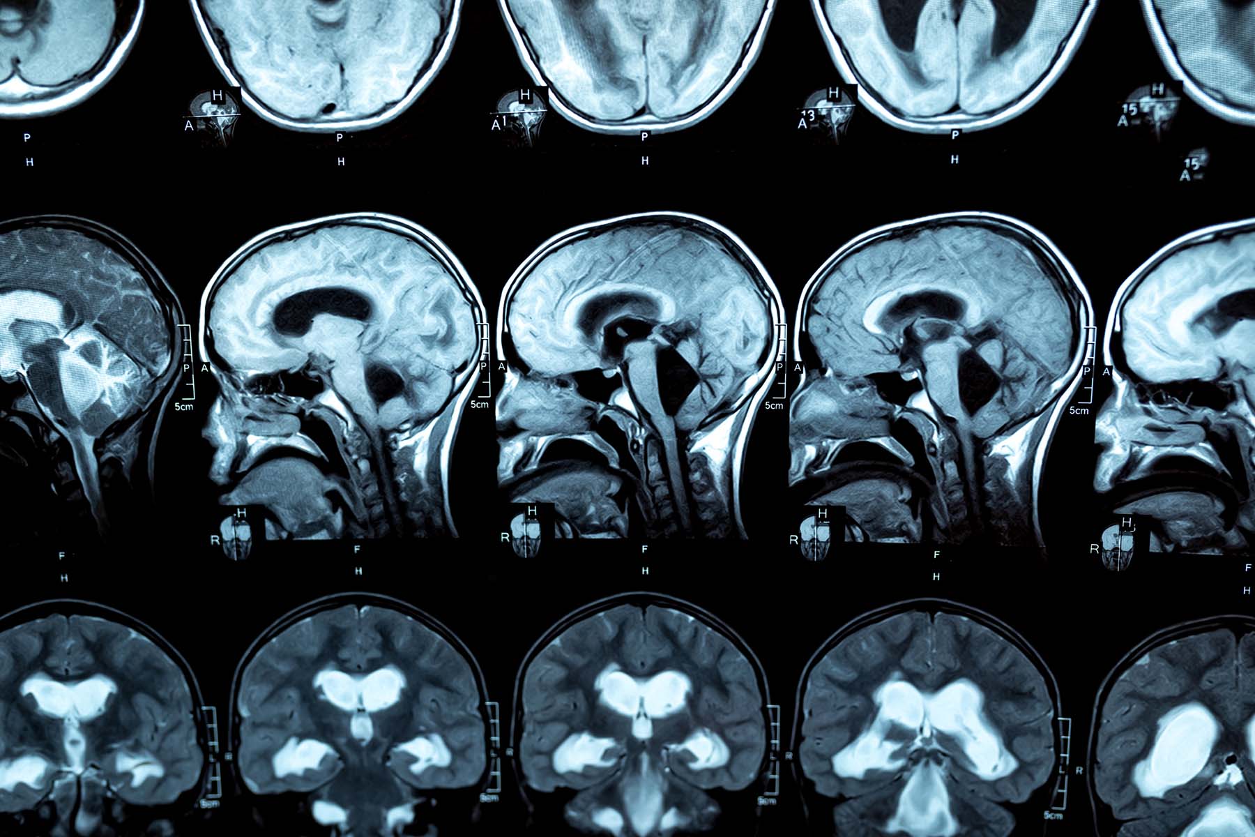 Brain (Cerebrospinal) Fluid Leaks | Dr. Jonathan Yip | Nasal, Sinus and Skull Base Surgery | Calgary ENT Specialist